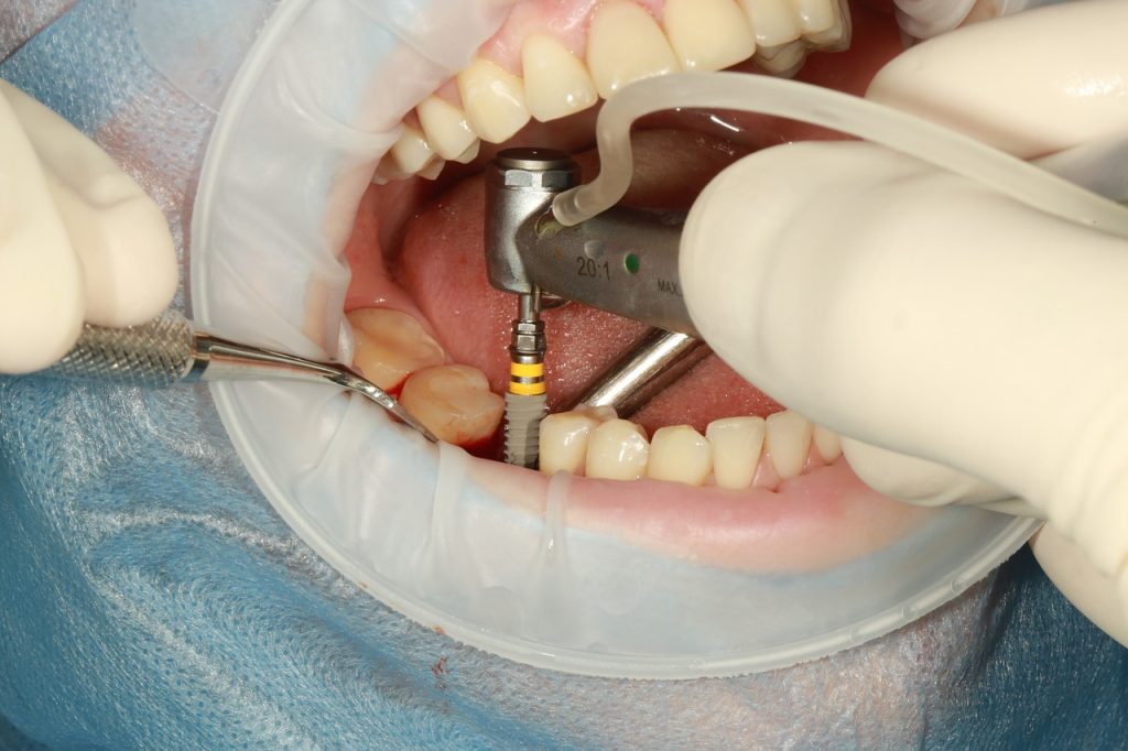 What are dental implants